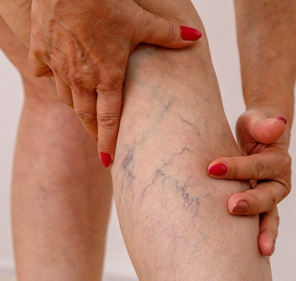 Red Vein Removal Image