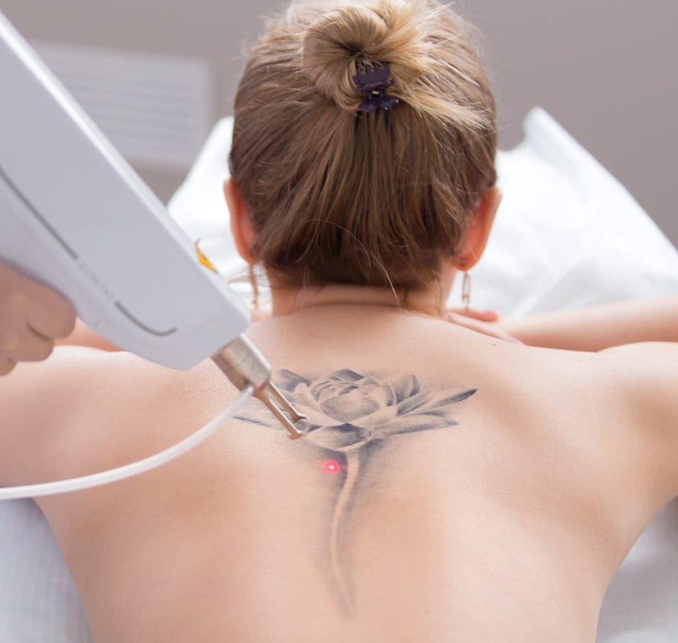 Tattoo Removal Image